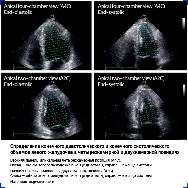 Определение конечного диастолического и конечного систолического объемов левого желудочка